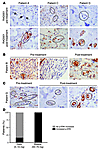 Phosphorylation of ERK in human cancer specimens upon RAD001 treatment.