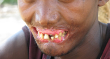 Man with severe scars around mouth, no lips