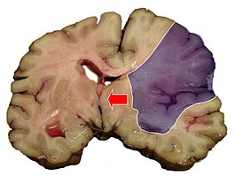 Hersendeel met infarct in het ACM-stroomgebied