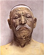 Face mildly deformed by leprosy, 1905