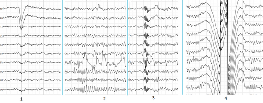 Common artifacts in human EEG. 1: Electrooculographic artifact caused by the excitation of eyeball's muscles (related to blinking, for example). Big-amplitude, slow, positive wave prominent in frontal electrodes. 2: Electrode's artifact caused by bad contact (and thus bigger impedance) between P3 electrode and skin. 3: Swallowing artifact. 4: Common reference electrode's artifact caused by bad contact between reference electrode and skin. Huge wave similar in all channels.