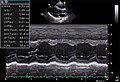 Sol mədəciyin parasternal uzun ox kəsiyində M-rejimdə görüntüsü