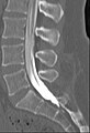 Computed tomography after conventional myelography. The overlap-free representation often allows a more secure assessment. The high density of contrast material may be troublesome in case of insufficient mixing prior to CT.