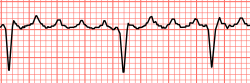 Atrial flutter34.svg