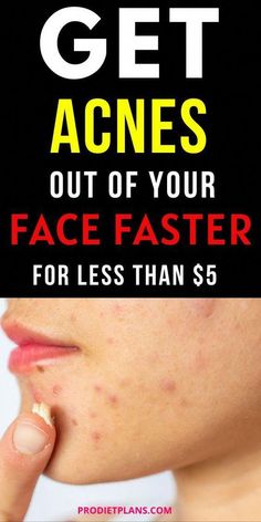 Pimple Remedies Overnight, Pimple Remedies, Remedies For Pimples, Face Pimples, Pimples On Scalp, Get Rid Of Pimples Overnight, Rid Of Pimples Overnight, Seasonal Skincare