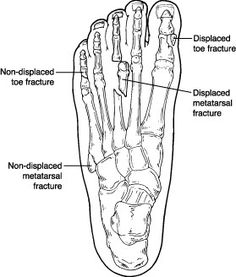 Toe Fracture Swollen Feet Remedies, Feet Remedies, Natural Diuretic, Bone Fracture, Sprained Ankle, Medical Education, Natural Home Remedies