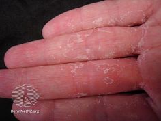 Home Remedies for Sweaty Hands - Top 7 Tested Home Remedies for Sweaty Hands and Palms by PHIBIE BARNS | This newsletter was created with Smore, an online tool for creating beautiful newsletters for educators, nonprofits, businesses and more Skin Peeling On Hands, Nail Infection, Aging Beauty, Receding Gums, Face Wrinkles, Home Health Remedies, Healthy Liver