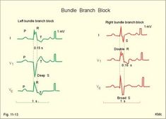 New Human Physiology Ch 11 Ekg Rhythms, Paramedic Student, Cardiac Nurse