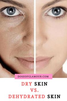 Dry Patchy Skin On Face, Dehydrated Skin Face, Dry Irritated Skin On Face, Dehydrated Skin Care Routine, Dehydrated Face, Redness Skincare, Hormonal Acne Skincare Routine, Hormonal Acne Skincare, Dry Skin Home Remedies