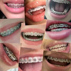 Silver Power Chain Braces, Silver Braces Color, Heart Braces, Color Of Braces, Brackets Aesthetic, Perfect Teeth Braces, Best Braces Colors, Braces Colors Combinations, Braces Aesthetic