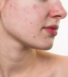 Red spots on the face can give you a blotchy and uneven skin tone. This article offers holistic and natural home remedies to reduce their appearance. Read on! Red Bumps On Face, Red Spots On Face, Redness On Face, Ankle Swelling, Redness Pimple, Rash On Face, Home Remedies For Skin