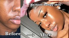 How To Get Rid Of Skin Texture, Flaky Skin On Face, Smooth Skin Face, Everyday Skincare Routine, Everyday Skin Care Routine, Textured Skin, Face Routine, Everyday Skincare, Dry Skin On Face