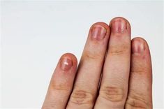 Dark Red Marks On Nails. There are any references about Dark Red Marks On Nails in here. you can look below. I hope this article about Dark Red Marks On Nails can be useful for you. Please remember that this article is for reference purposes only. #dark #red #marks #on #nails Red Lines On Nails, Nails After Acrylics, Red Streaks, Spooky Nails, Lines On Nails