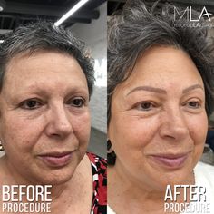 PHOTOS & VIDEO: Eyebrow Microblading for Cancer Survivors and FAQ Permanente Make-up, Eyebrow Microblading, Microblading Eyebrows, Eyebrow Shape, Beauty Tips And Tricks, Skin Diseases, Prevent Wrinkles, Moisturizing Body Wash, Spf Sunscreen