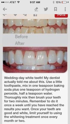 Whiten Teeth With Baking Soda, Baking Soda Teeth, Baking Soda Teeth Whitening, Teeth Whitening Homemade, Teeth Whitening Remedies, Teeth Whitening Diy, Charcoal Teeth Whitening, Pasta Dental, Whiten Teeth