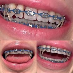 Midnight Glow Braces, Braces Chain Colors, Teeth Braces Colors, Power Chain Braces Colors Ideas, Braces Aesthetic Colors, Light Purple Braces, Braces Colors Ideas Power Chains, Braces With Rubber Bands, Brace Colors Ideas