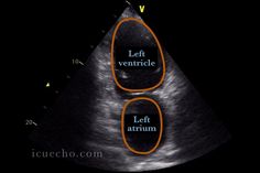 an x - ray shows the left ventricil and left atrium, which are labeled in orange