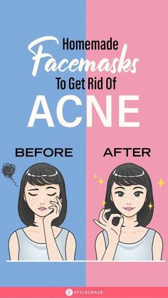 A DIY face pack can reduce acne and improve overall skin health. Learn about 15 effective and easy homemade face packs for acne and oily skin to make at home. Pimple Free Skin, Homemade Face Pack, Acne Free Skin, Acne Skincare, Diy Acne