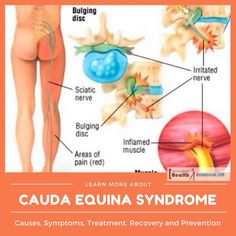 an image of the caudaa equinna syndrome and its associated functions in human body