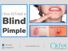 Get rid of unwanted bumps from the face and skin with holistic advanced acne treatment at Oliva Clinics. Safe & Effective treatment for all kinds of acne/pim... Pimple Under The Skin, Abdominal Pain Relief, Blind Pimple, Pimples Overnight, Prevent Pimples, Acne Removal, Dark Underarms, Under The Skin