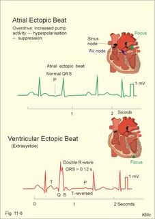 an ectopic beat is shown in this diagram