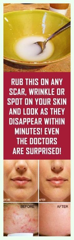 Thanks a million. Super-duper advice! Eliminate Wrinkles, Skin Remedies, Beauty Tricks, Skin Care Acne, Facial Skin, Looks Style