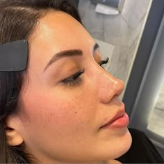 Nonsurgical Nose Job, Nose Plastic Surgery, Nose Job Inspo, Nose Fillers, Rhinoplasty Before And After, Nose Jobs, Rhinoplasty Surgery