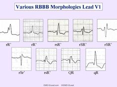 Nurse Betty, Nursing School Life, Cardiac Rhythms, Flight Nurse