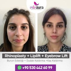 Tip Rhinoplasty Before After, Plastic Surgery Aesthetic, Rhinoplasty Before And After Bulbous, Nose Surgery Rhinoplasty, Rhinoplasty And Chin Augmentation, Face Plastic Surgery, Rhinoplasty Bulbous Tip, Rhinoplasty Before After Dorsal Hump, Face Fillers