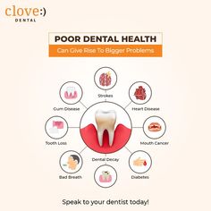 Clove Dental, Dental Wall Art, Dental Decay, Dental Check Up, Dental Posters, Medical Tools, Dental Tips, Dental Fun