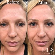 OMG! Brows on FIRE🔥 this Friday! What an amazing transformation a little bit of color and shape can do for the face! 🤤😍 #microblading #pmu Eyebrow Goals, Eyebrows Goals, Cosmetic Tattooing, Beautiful Eyebrows, Eyebrow Tinting, Cosmetic Tattoo, Look Into My Eyes, Microblading Eyebrows, Eyebrow Shaping