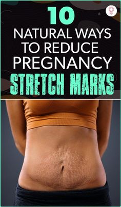 Pregnancy stretch marks are inevitable. However, with proper care, you can improve their appearance. Click here to learn home remedies and preventive tips Strech Marks, Strong Healthy Hair, Stretch Mark Remedies, Wrinkle Skin Care, Dry Oily Skin, Best Anti Aging Skin Care, Acne Prone Skin Care, Healthy Hacks, Tips For Oily Skin