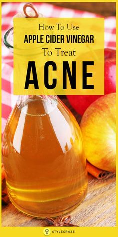 how to use apple cider vinegar to treat acne