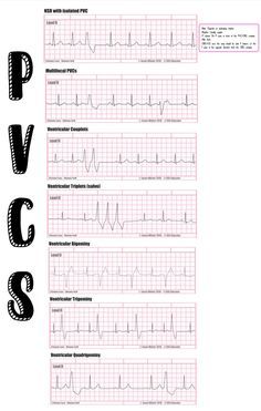 Ekg Reading, Medic School, Paramedic Study, Body Knowledge, Ekg Rhythms, Nursing Knowledge, Nursing Hacks, Bsc Nursing, Medical Assistant Student