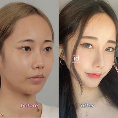 Job Goals, Rhinoplasty Before And After, Online Counseling, Double Eyelid, Passport Photo, Breast Surgery