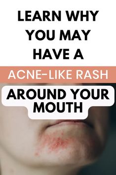 Put down the hydrocortisone and listen to this skincare expert discuss why you're experiencing this rash around the mouth and the proper way to get rid of it for good! Rash Around Mouth, Face Rash Remedies, Home Remedies For Rashes, Rashes Remedies, Natural Mouthwash, Itchy Rash, Cleanser For Sensitive Skin, Get Rid Of Pimples