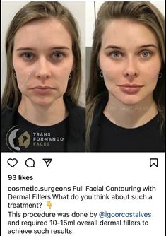 Dermal Fillers, Lip Fillers, Anti Aging Skin Products, Surgery, Anti Aging, Facial, Beauty Hacks