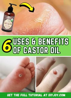 Castor Oil As Carrier Oil, Castor Oil For Hemmoroids, Caster Oil Uses, Castor Oil Benefits Skin, Castrol Oil, Castor Oil For Skin