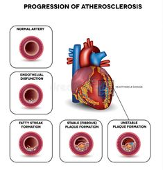 the progression of an atheroscleous heart and how it affects blood flow