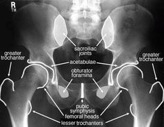 an x - ray shows the location of the pectoral fibrosis