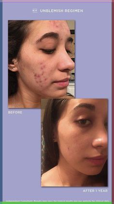 Discover effective solutions for adult acne treatment. From clear skin strategies to ageless confidence, explore remedies that empower your skin. Say goodbye to breakouts and embrace a radiant complexion with insights that make adult acne care simple and effective. #acnetreatment #adultacne #adultacnetreatment #hormonalacnetreatment #adultacnetreatent #whatcausesadultacne #acnetreatments Face Glowing, Skincare For Acne, Business Card Texture, Acne Treatments, Clear Skin Tips, Acne Care, Acne Free, Beauty Remedies, Acne Marks