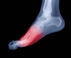 Metatarsalgia Heel Pain, Nerve Pain, Foot Pain, X Ray, Just In Case, Running, Heels