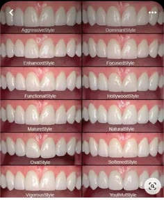 Cosmetic Dentistry Procedures, Veneers Teeth, Dental Anatomy, Beautiful Teeth, Porcelain Veneers, Perfect Teeth, Teeth Shape, Dental Veneers, Dental Art