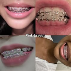 Cute Color Braces Ideas, Light Pink Braces Aesthetic, Braced Teeth, Braces Inspo Colors, Pink Braces Black Women, Pink Power Chain Braces, Clear Braces With Color Bands, Hot Pink Braces