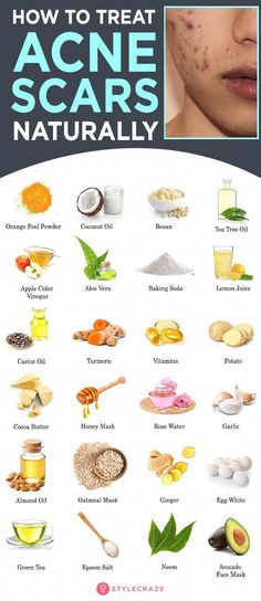 Natural remedies are an effective alternative to surgery or harsh techniques for treating acne scars. These 12 remedies can help lighten your scars gently. Skin Care For Acne, Baking Soda Lemon Juice, Baking Soda And Lemon, Turmeric Vitamins, Get Rid Of Acne, Rid Of Acne, Natural Acne, Home Remedies For Acne