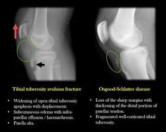 an x - ray shows that the knee is broken and has been replaced with surgery