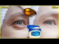 In 3 days Remove Under Eye Bags Completely | Remove Dark Circle, Wrinkles, Puffy EyesDark circles under the lower eyelid are common in both men and women. Da... Dark Circle, Dark Circles, Wrinkles, Circles