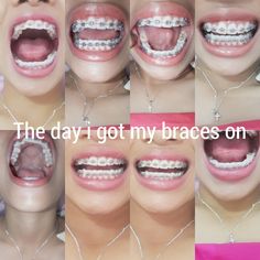 Hayyyaaaah it hurts like fack i kennot huhuhuh Foods To Eat With Braces, Braces Types, Power Chains, Tooth Braces, Invisible Teeth Braces