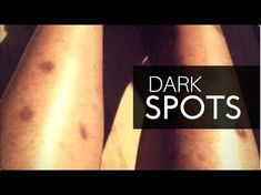 HOW TO GET RID OF DARK SPOTS ON LEGS & BODY FAST | GET CLEAR EVEN SKIN TONE ALL OVER! - YouTube Black Spots On Legs Remove, Hyperpigmentation On Legs Dark Spots, Dark Spots And Hyperpigmentation, Black Spots On Face Remove Fast, How To Get Rid Of Scars On Legs Diy, How To Get Rid Of Mosquito Bites Fast, How To Remove Scars On Legs Fast, Autoimmune Symptoms, Clear Even Skin