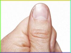 Your fingernails can reveal a lot about the state of your health. Conditions ranging from stress to thyroid disease may be causing changes in your nails. Moons On Fingernails, Pitted Nails, Toothache Relief, Almond Blue Nails, Nail Purple, Lichen Planus, Split Nails, Nail Natural, Tooth Ache Relief